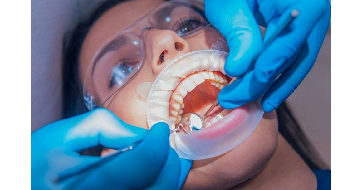 Dental Cleaning, Scaling and Polishing