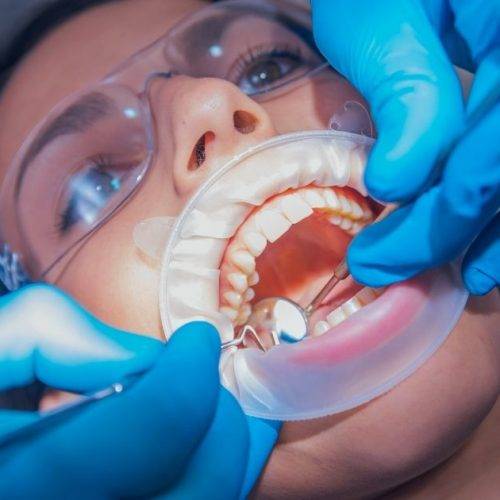 Dental Cleaning, Scaling and Polishing