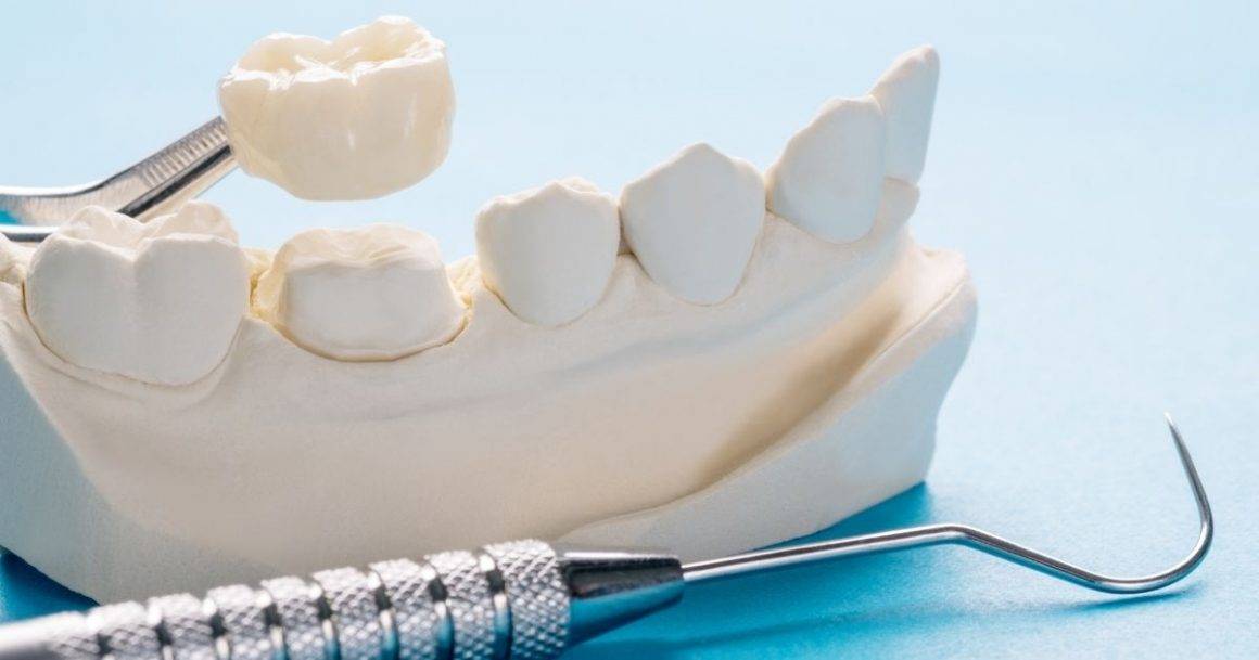 Dental Crowns