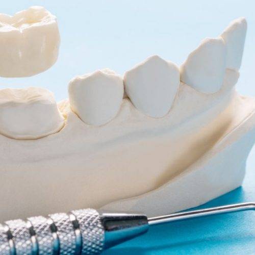 Dental Crowns