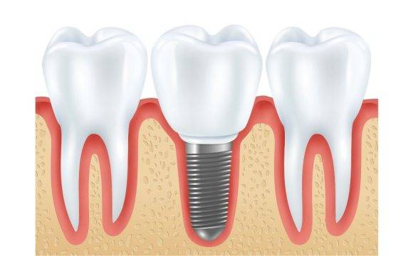 Dental Implants