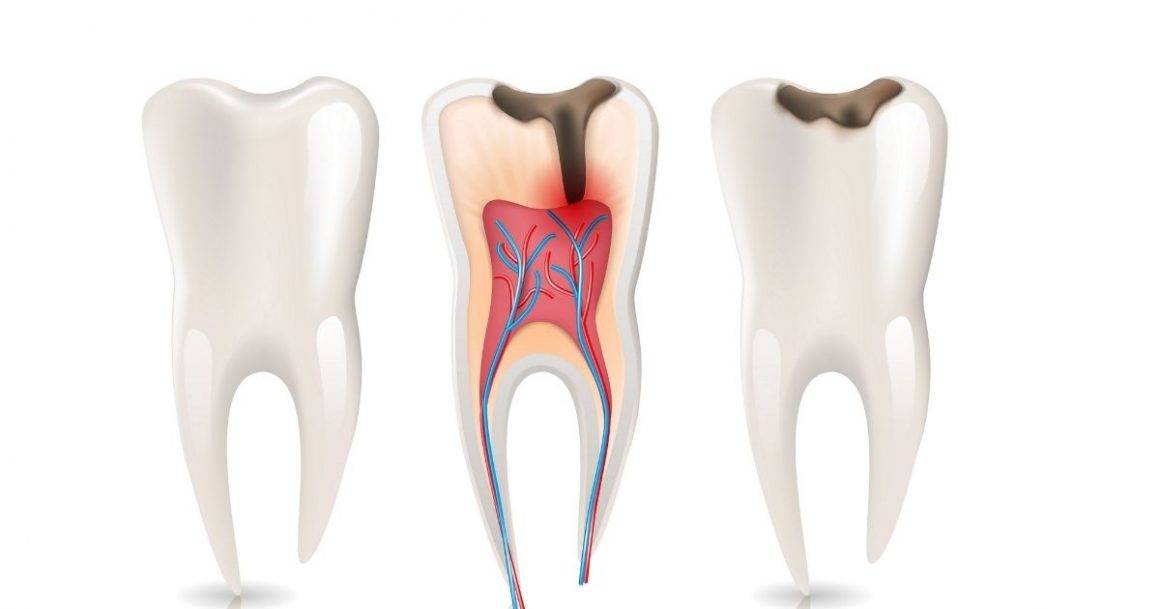 Root Canal Treatment - Shawn Lin DDS 林轩牙医博士