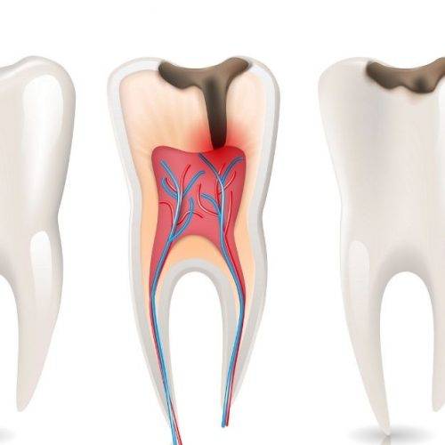 Root Canal Treatment