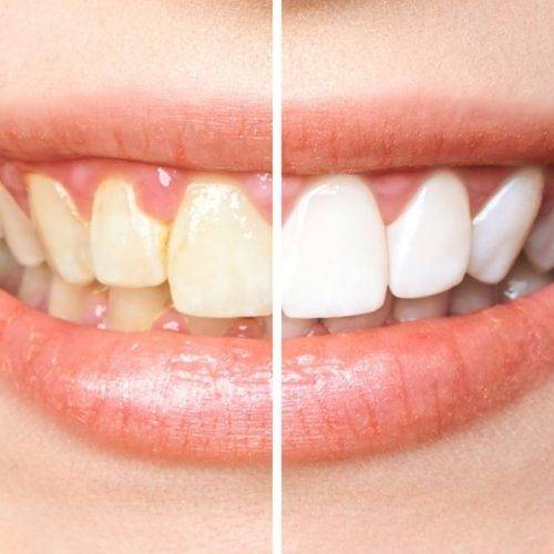 Teeth Whitening