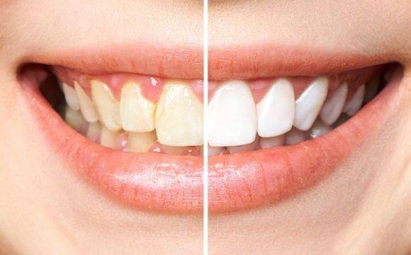 Teeth Whitening