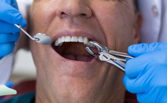 Tooth Extraction