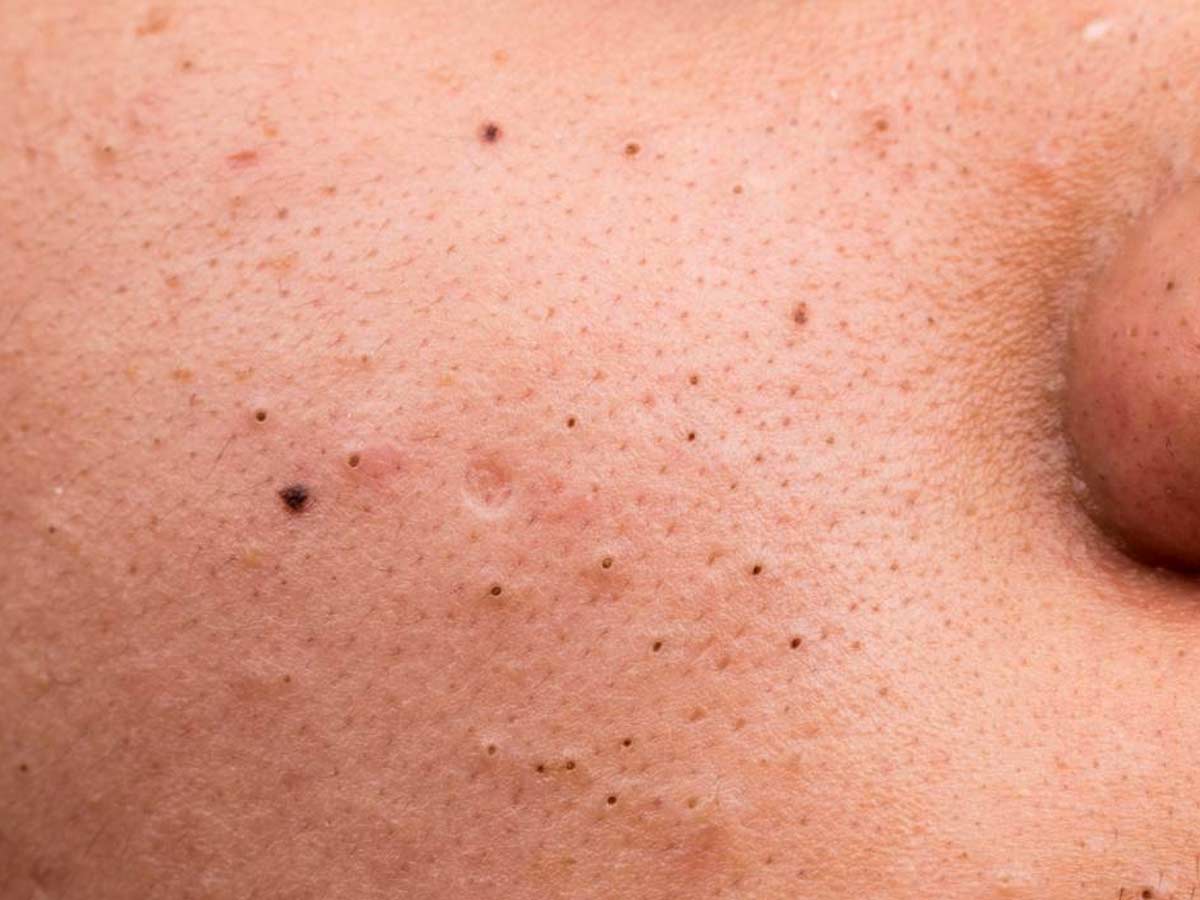 black heads