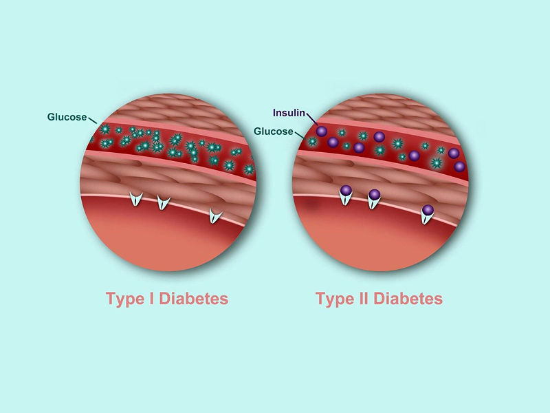 ,diabetes ,diabetes symptoms ,type 2 diabetes ,type 1 diabetes ,gestational diabetes ,signs of diabetes ,diabetes insipidus ,diabetes mellitus ,what causes diabetes ,type 1 diabetes symptoms ,diabetes association ,diabetes a1c ,diabetes and covid ,,diabetes awareness month type 2 diabetes ,type 2 diabetes symptoms ,type 1 vs type 2 diabetes ,type 2 diabetes diet ,can you reverse type 2 diabetes ,type 2 diabetes medications ,type 2 diabetes mellitus ,type 2 diabetes treatment ,type 2 diabetes icd 10 ,how to reverse type 2 diabetes ,type 2 diabetes food list ,is type 2 diabetes genetic ,type 2 diabetes and pregnancy