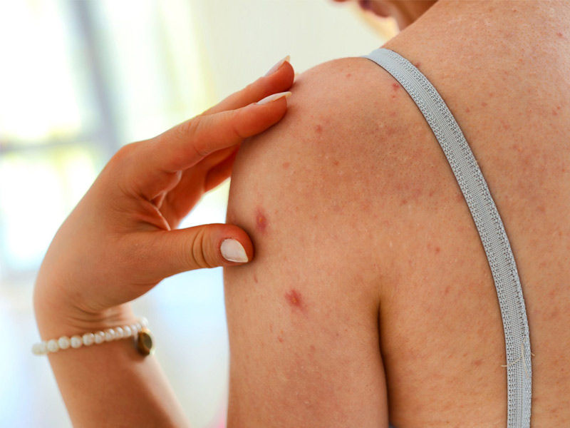 All That You Need To Know About The Troublesome Back Acne