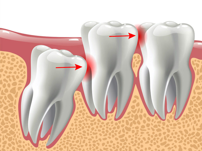 wisdom tooth, wisdom tooth pain, wisdom tooth extraction, impacted wisdom tooth, infected wisdom tooth, infected wisdom tooth symptoms, how to stop wisdom tooth pain, side effects of wisdom tooth extraction, dry socket wisdom tooth, early stage wisdom tooth infection, wisdom tooth after care, wisdom tooth anesthesia, wisdom tooth age, wisdom toothache, wisdom tooth after removal, at home remedies for wisdom tooth pain, best thing for wisdom tooth pain, cure for wisdom tooth pain, wisdom tooth discomfort, does wisdom tooth pain go away