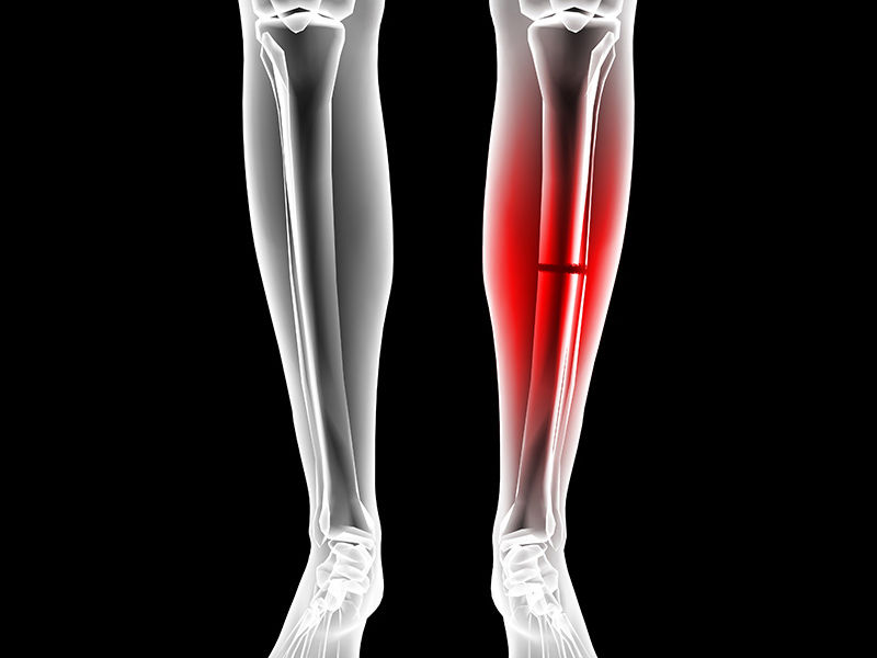 ,coccydynia ,coccydynia icd 10 ,coccydynia treatment ,chronic coccydynia ,coccydynia exercises ,how long does coccydynia last ,coccydynia pillow ,chronic coccydynia treatment ,coccydynia exercises pdf ,coccydynia physical therapy ,coccydynia radiology