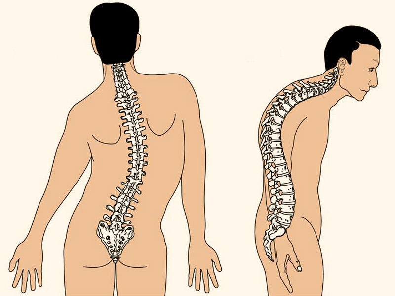 scoliosis, scoliosis treatment, scoliosis definition, scoliosis surgery, what causes scoliosis, mild scoliosis, lumbar scoliosis, scoliosis brace, types of scoliosis, scoliosis icd 10, idiopathic scoliosis, scoliosis awareness month, scoliosis and pregnancy, scoliosis and sciatica, scoliosis and hip pain, scoliosis as an adult, scoliosis arthritis, scoliosis assessment, scoliosis angle, scoliosis and chiropractor, adolescent idiopathic scoliosis