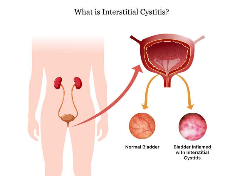 ,uti ,uti symptoms ,u,ti treatment ,a,ntibiotics for uti ,uti medicine ,home remedies for uti ,how to get rid of a uti ,uti causes ,,ciprofloxacin for uti ,uti symptoms men uti antibiotics ,uti after sex ,uti at home treatment ,uti and pregnancy