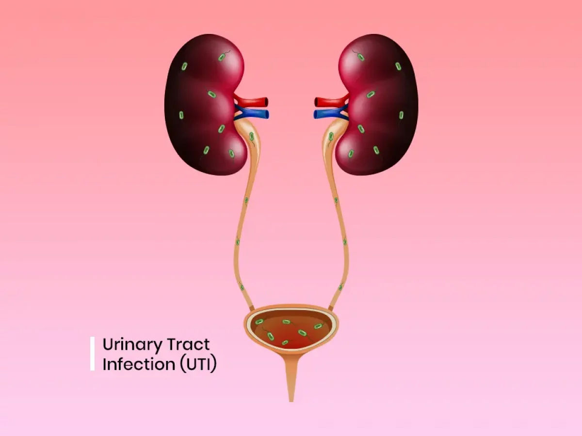 Urinary Tract Infection Causes, symptoms, and treatment Voices