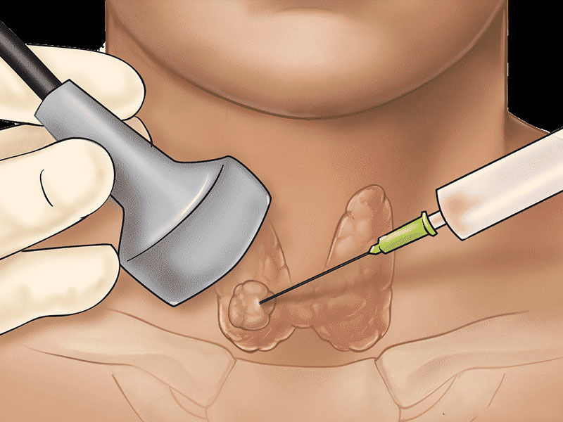 pott's disease, pott's disease heart, pott's disease symptoms, pott's disease cause, is pott's disease contagious, pott's disease diagnosis, how to prevent pott's disease, pott's disease treatment, pott's disease complications, is pott's disease curable, pott's disease autoimmune, pott's disease affects, pott's disease bone, pott's disease biopsy