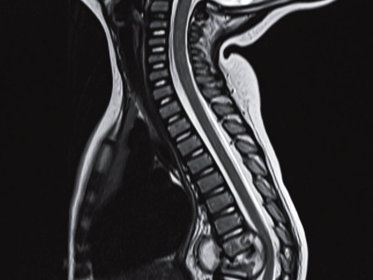 Potts Disease 1200x900@thelancet 