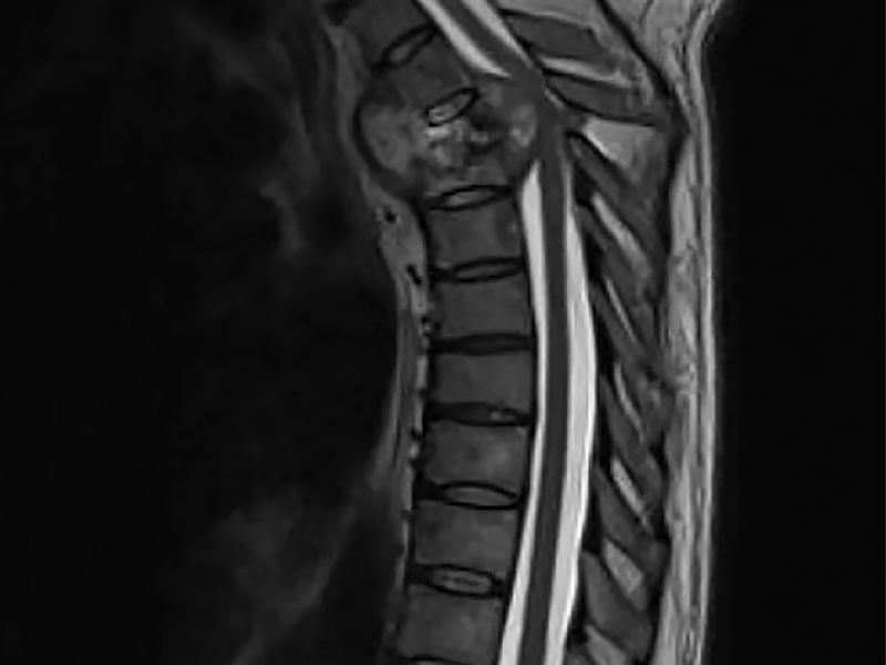 pott's disease, pott's disease heart, pott's disease symptoms, pott's disease cause, is pott's disease contagious, pott's disease diagnosis, how to prevent pott's disease, pott's disease treatment, pott's disease complications, is pott's disease curable, pott's disease autoimmune, pott's disease affects, pott's disease bone, pott's disease biopsy