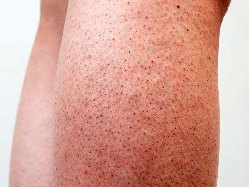 kerotosis pilaris,keratosis pilaris, keratosis pilaris treatment, how to get rid of keratosis pilaris, keratosis pilaris arms, keratosis pilaris face, keratosis pilaris legs, keratosis pilaris causes, what causes keratosis pilaris ,keratosis pilaris cream ,keratosis pilaris toddler ,best treatment for keratosis pilaris ,keratosis pilaris and gluten ,keratosis pilaris ammonium lactate ,keratosis pilaris atrophicans ,keratosis pilaris arms treatment ,keratosis pilaris all over body ,keratosis pilaris and tattoos