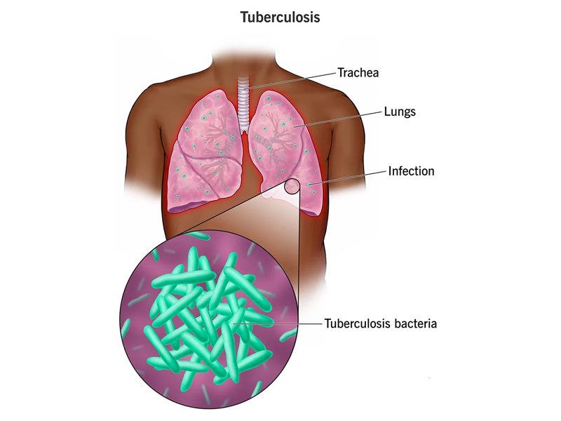 Prueba de tuberculosis positiva fotos