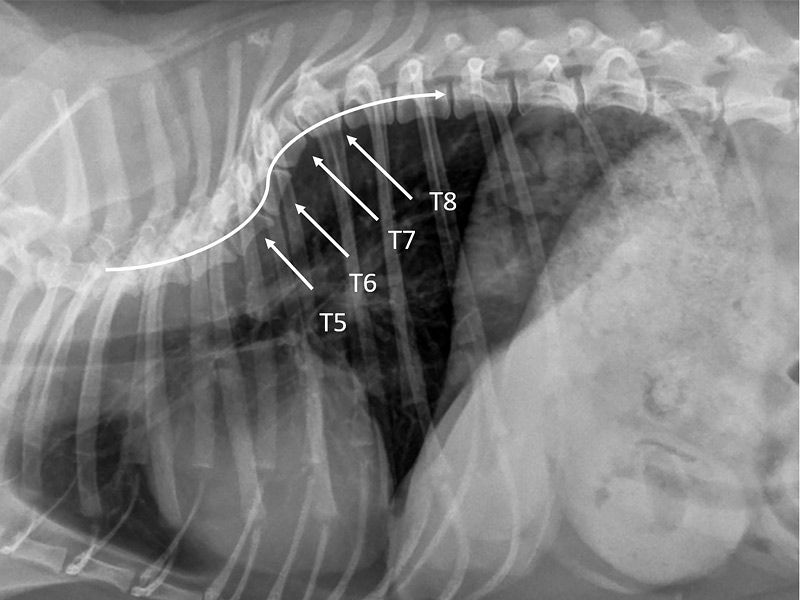 Pott's Disease Causes, Signs, Diagnosis and Treatment