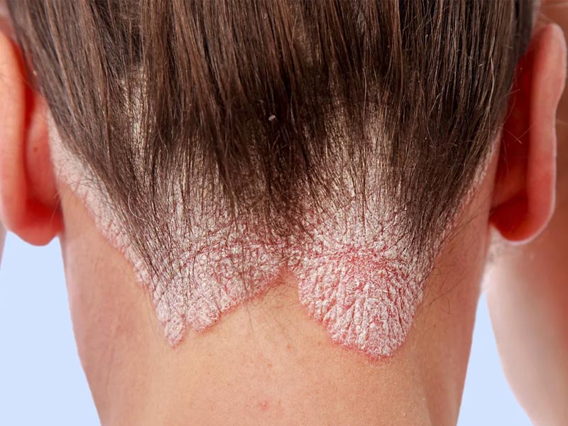 vitiligo,
vitiligo treatment,
vitiligo causes,
vitiligo symptoms,
vitiligo skin,
vitiligo pronunciation,
vitiligo definition,
is vitiligo hereditary,
is vitiligo genetic,
opzelura vitiligo
,how does vitiligo start
vitiligo autoimmune
,vitiligo awareness month
,vitiligo around eyes
,vitiligo and thyroid
,vitiligo age of onset
,vitiligo and lupus
,vitiligo and sun exposure
,vitiligo around mouth