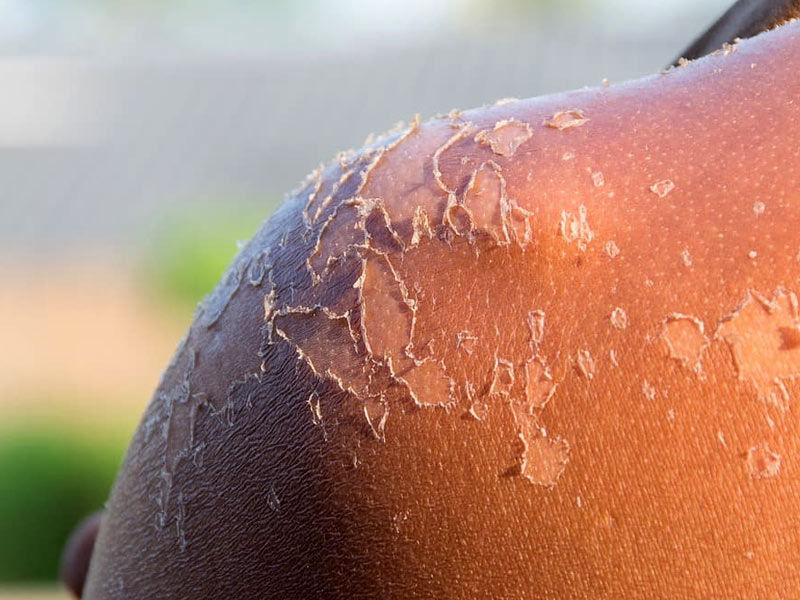 vitiligo,
vitiligo treatment,
vitiligo causes,
vitiligo symptoms,
vitiligo skin,
vitiligo pronunciation,
vitiligo definition,
is vitiligo hereditary,
is vitiligo genetic,
opzelura vitiligo
,how does vitiligo start
vitiligo autoimmune
,vitiligo awareness month
,vitiligo around eyes
,vitiligo and thyroid
,vitiligo age of onset
,vitiligo and lupus
,vitiligo and sun exposure
,vitiligo around mouth
