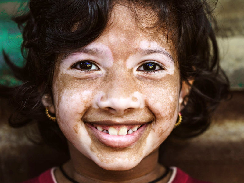 vitiligo,
vitiligo treatment,
vitiligo causes,
vitiligo symptoms,
vitiligo skin,
vitiligo pronunciation,
vitiligo definition,
is vitiligo hereditary,
is vitiligo genetic,
opzelura vitiligo
,how does vitiligo start
vitiligo autoimmune
,vitiligo awareness month
,vitiligo around eyes
,vitiligo and thyroid
,vitiligo age of onset
,vitiligo and lupus
,vitiligo and sun exposure
,vitiligo around mouth