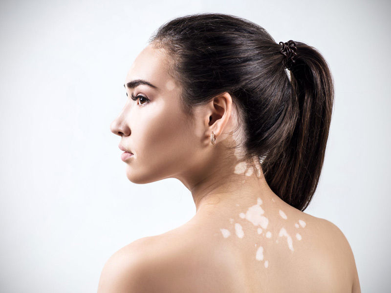 vitiligo,
vitiligo treatment,
vitiligo causes,
vitiligo symptoms,
vitiligo skin,
vitiligo pronunciation,
vitiligo definition,
is vitiligo hereditary,
is vitiligo genetic,
opzelura vitiligo
,how does vitiligo start
vitiligo autoimmune
,vitiligo awareness month
,vitiligo around eyes
,vitiligo and thyroid
,vitiligo age of onset
,vitiligo and lupus
,vitiligo and sun exposure
,vitiligo around mouth
