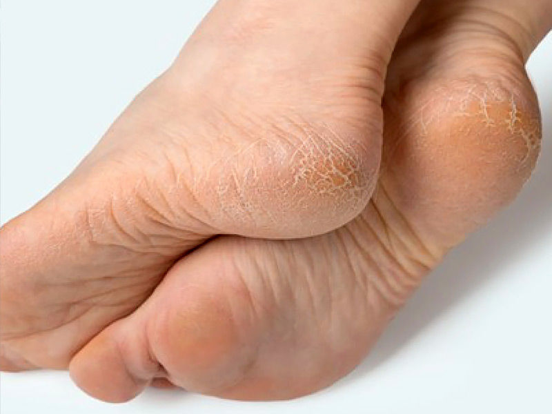 ,cracked heels,how to fix cracked heels permanently
,how to heal cracked heels
,what causes cracked heels
,painful cracked heels
,best foot cream for cracked heels
,home remedies for cracked heels
,what causes dry cracked heels
,painful cracked heels remedy
,cream for cracked heels
,foot cream for cracked heels