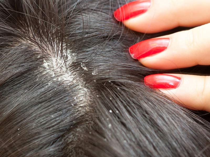 ,natural dandruff remedies,cat dandruff remedies
,puppy dandruff remedies
,anti dandruff remedies
,dandruff remedies reddit
,home dandruff remedies for dry scalp
,dry scalp dandruff remedies
,dandruff remedies for dogs
,how to remove dandruff remedies
,dandruff remedies at home in hindi
,dandruff remedies at home
,dandruff remedies at home in marathi