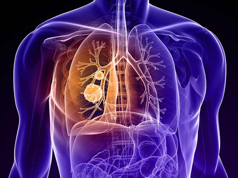 lung cancer,lung cancer symptoms
,signs of lung cancer
,stage 4 lung cancer
,small cell lung cancer
,lung cancer survival rate
,non small cell lung cancer
,lung cancer awareness month
,how i knew i had lung cancer
,lung cancer screening
,stage 1 lung cancer symptoms
