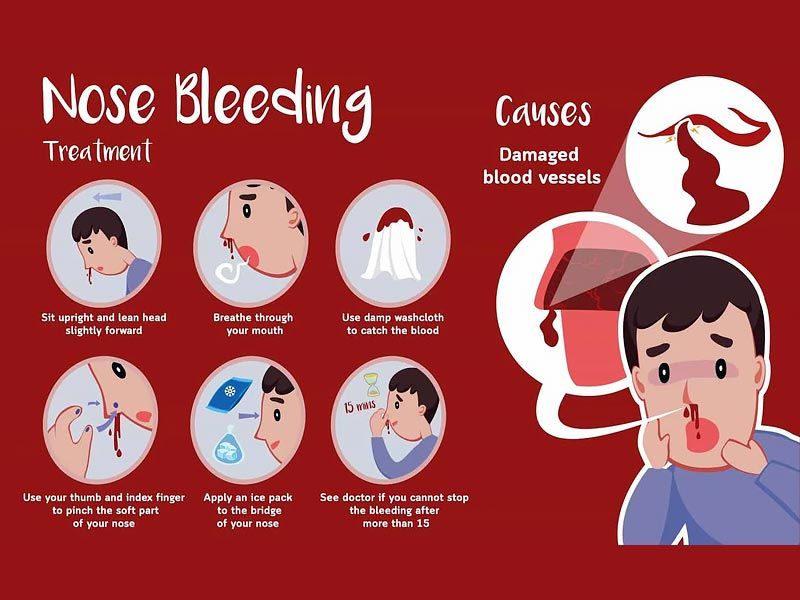 ,nosebleeding ,nose bleeding ,how to stop nose bleeding ,first aid for nose bleeding ,reasons for nose bleeding ,how to prevent nose bleeding ,dog nose bleeding ,nose bleeding cause ,what to do when you are nosebleeding ,nose bleeding in pregnancy ,nose bleeding while sleeping ,what causes nose bleeding ,nose bleeding a lot ,nose bleeding and headache