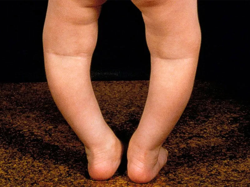 ,rickets ,rickets symptoms ,rickets disease ,rickets definition ,rickets treatment ,rickets causes ,rickets in children ,taylor swift tickets ,hypophosphatemic rickets ,rickets in adults ,rickets meaning ,rickets and osteomalacia ,rickets anatomy definition