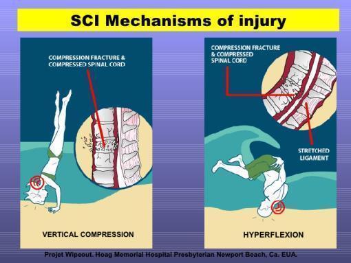 Second graphic of spinal cord injury diving into shallow water