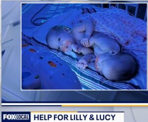 FOX Local coverage reads Help for Lilly & Lucy with a photo of the conjoined twin girls.