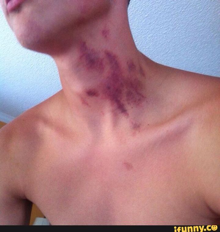 Bad why are hickies Why Are