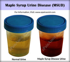 maple syrup urine disease