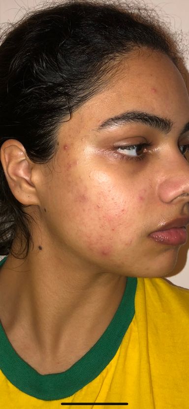 face with acne before