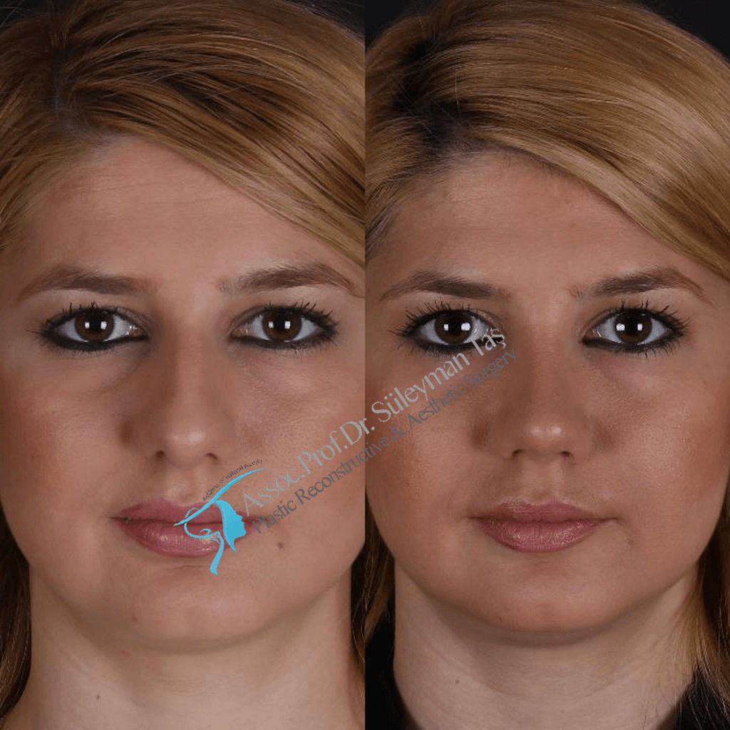How much does rhinoplasty cost in istanbul