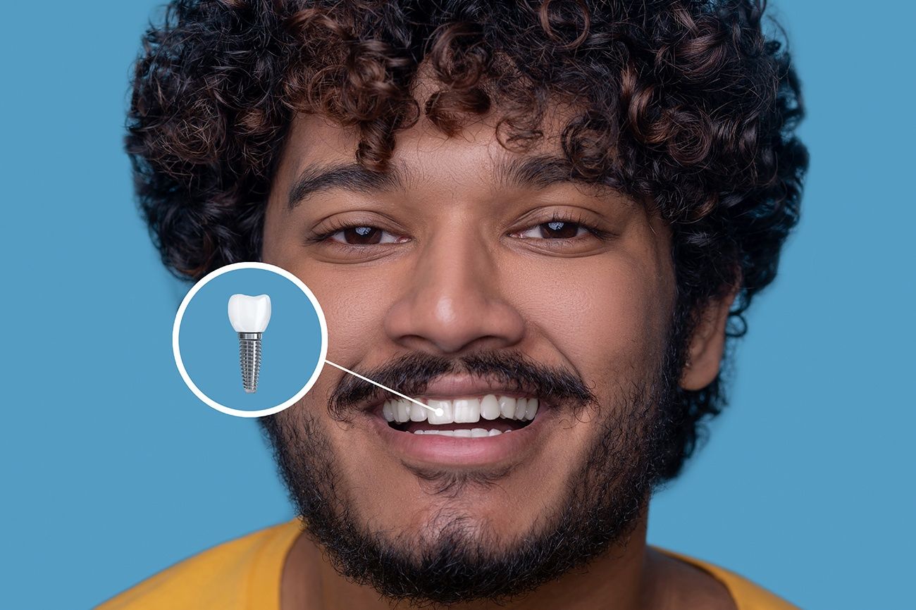 Understanding the Costs and Benefits of Full Mouth Dental Implants