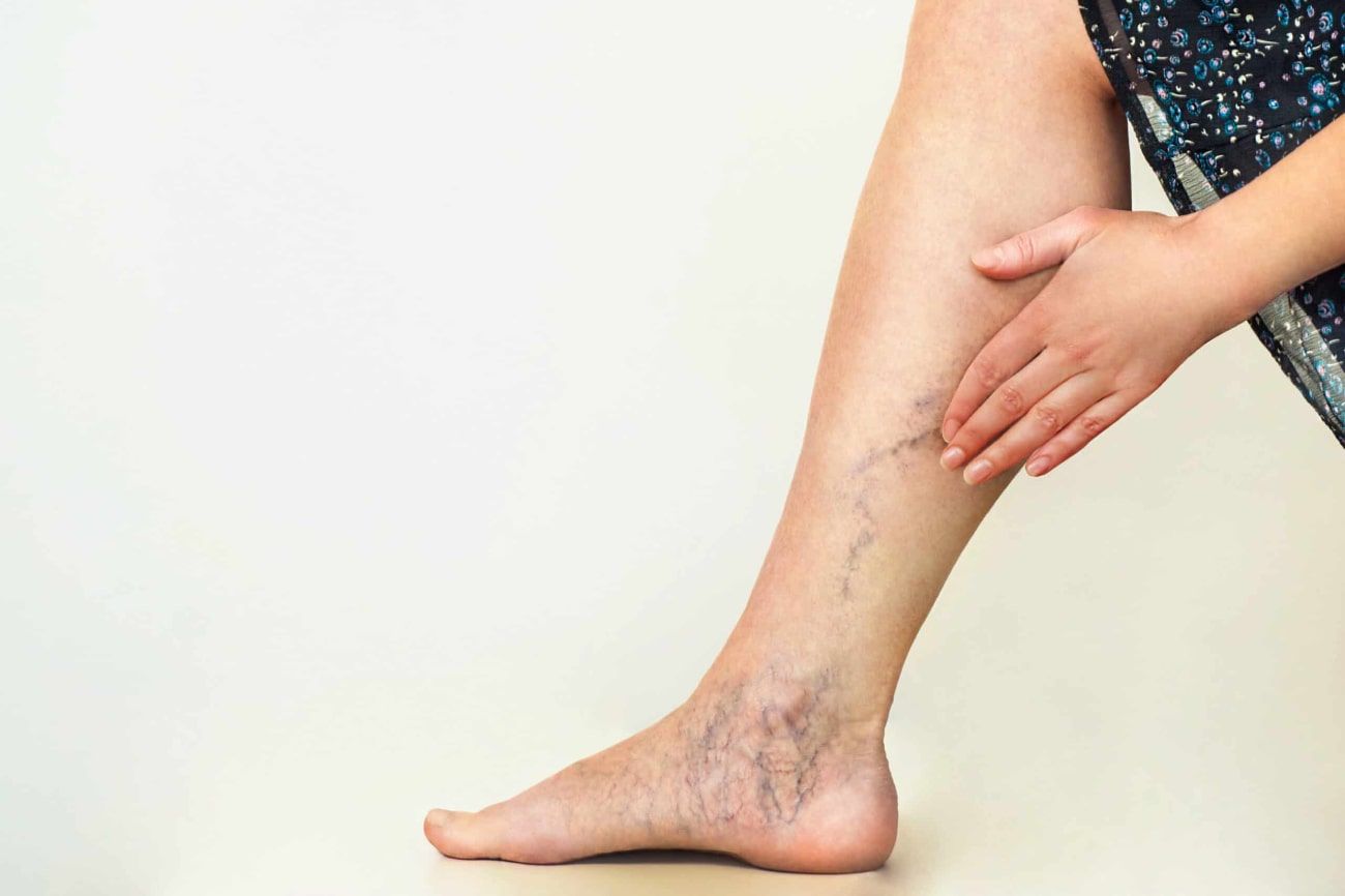 What Leads to Varicose Veins?