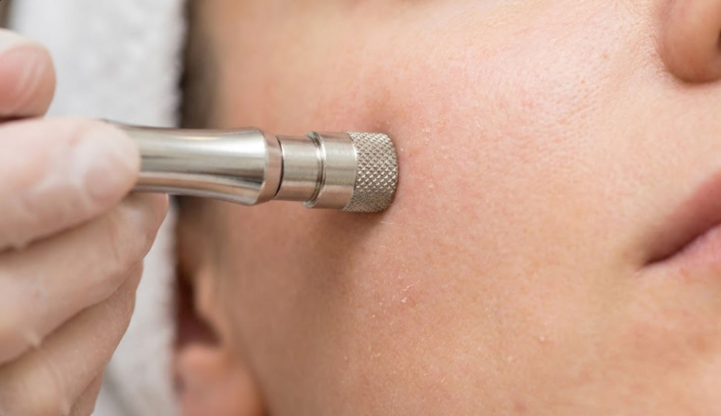 Comparativa Hydrafacial vs Microdermoabrasión: Diferencias de tratamientos faciales para limpieza profunda y rejuvenecimiento en Ella Skin & Spa Mérida