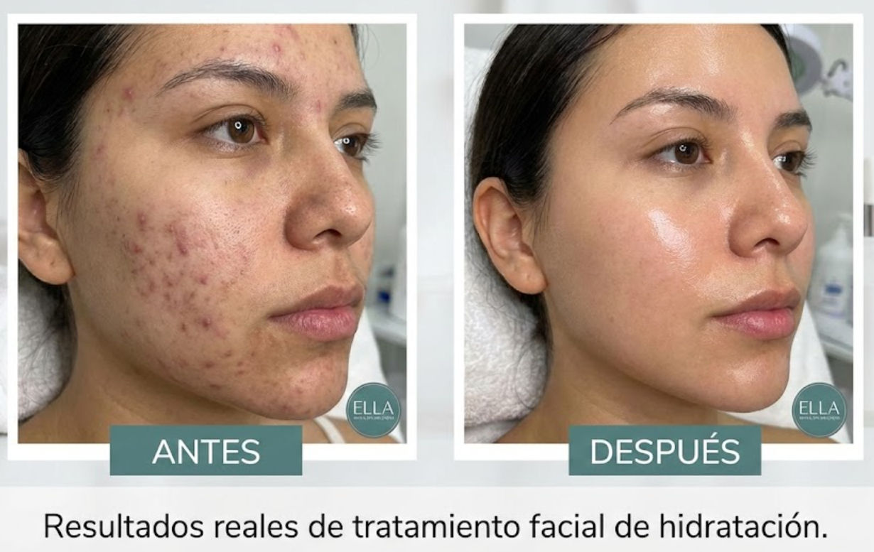 Resultados antes y después de tratamiento de acné en el mejor spa facial en Mérida - Ella Skin & Spa Wellness