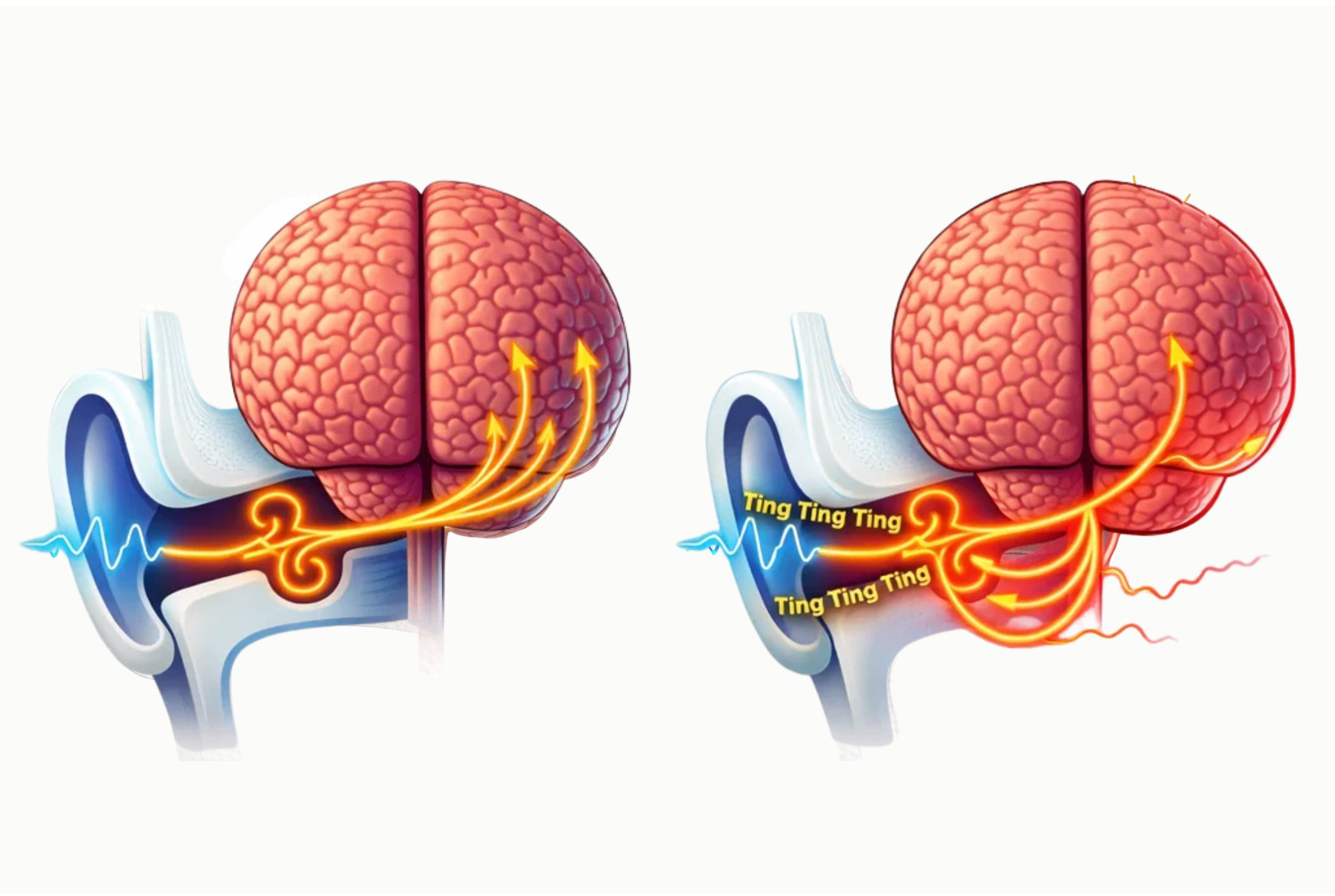 Damaged neural connections between ear hair cells and the brain