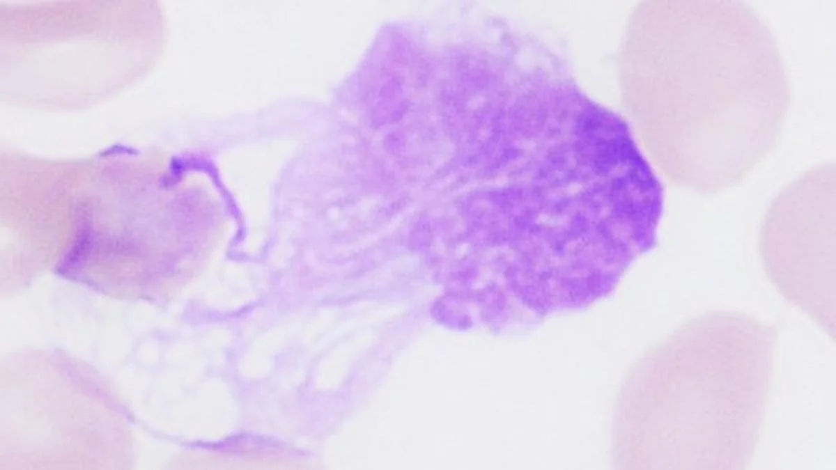 Understanding Chronic Lymphocytic Leukemia (CLL) Symptoms and Diagnosis