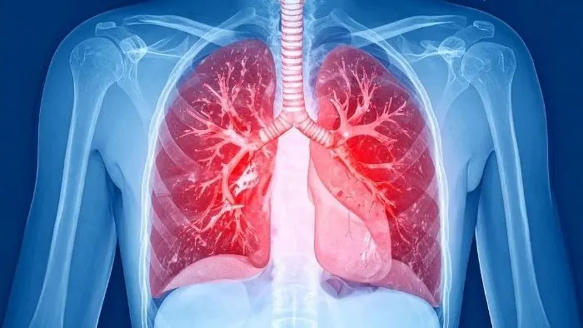 Drug-Resistant TB Cases Challenge Standard Diagnostic Capabilities In India
