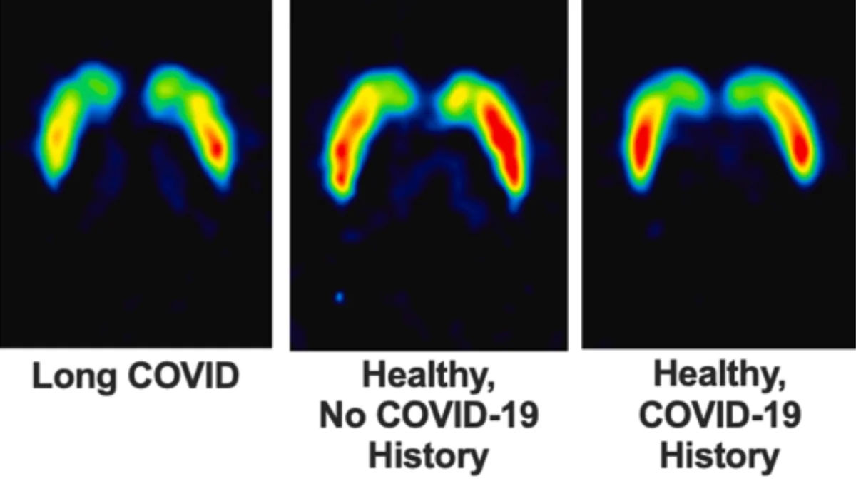 Long COVID Causes Lasting Brain Damage