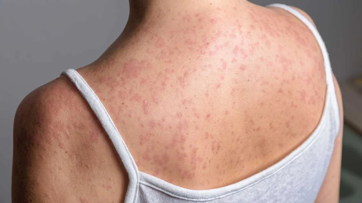 Measles Outbreak In Southern Iowa Hits 12 Confirmed Cases