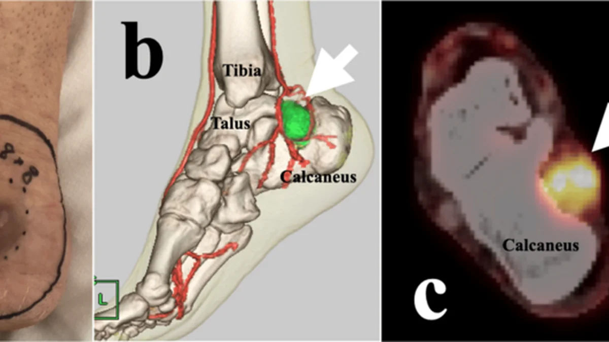 Palliative Stereotactic Body Radiotherapy for Metastatic Clear Cell Sarcoma