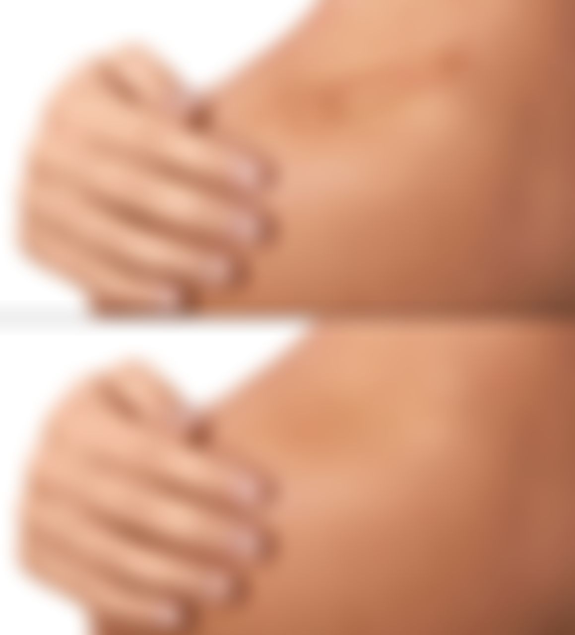 Scars treatments 